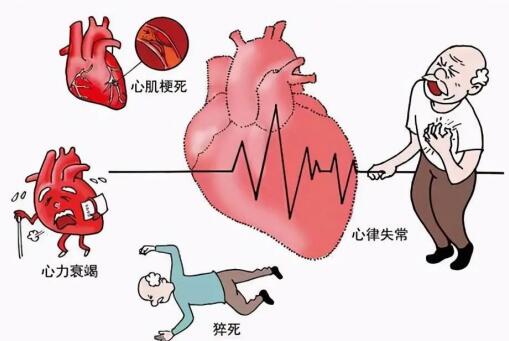 3,可并发严重的心律失常,心源性休克或急性心力衰竭,常危及生命.
